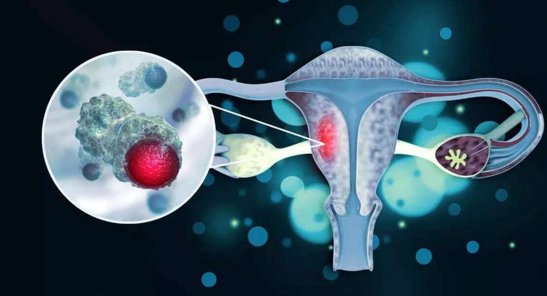 cervical cancer 1110x601 - What do you need to know about cervical Cancer?-cancer-MGIMS Hisar, MGIMS Haryana, Mahatma Gandhi Institute of Medical Sciences, cervical Cancer