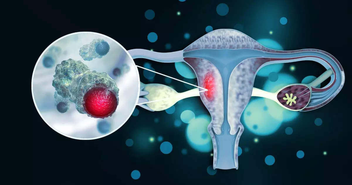 cervical cancer - What do you need to know about cervical Cancer?-cancer-MGIMS Hisar, MGIMS Haryana, Mahatma Gandhi Institute of Medical Sciences, cervical Cancer