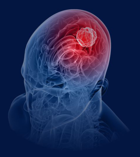 brain - ब्रेन ट्यूमर के लक्षणों को पहचानें और इलाज शुरू करें-surgery, oncology, cancer-
